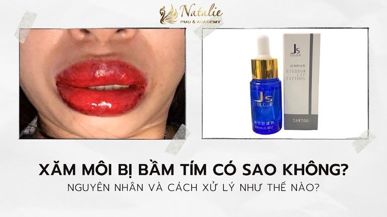 Xăm môi bị bầm tím liệu có bị sao không?